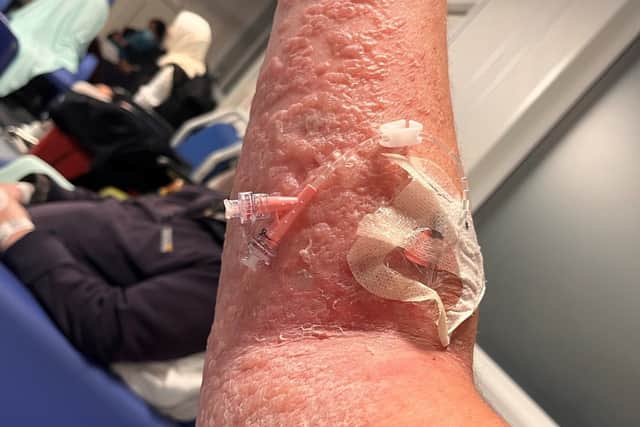 Amy's arm on February 2nd 2023. A woman had a holiday from hell after her skin peeled off and her hair and nails fell off when she was bitten by a tiger mosquito in the Caribbean.