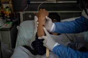 A doctor checks on a patient with sores caused by a mpox infection. (Photo: ERNESTO BENAVIDES/AFP via Getty Images)