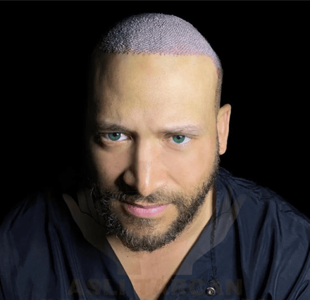 Aslı Tarcan Clinic is a leading destination for anyone considering hair transplant procedure in Turkey