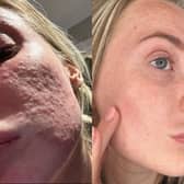 Real-life results: this user shared her skin journey after switching to a gentler, long-term skincare approach.
