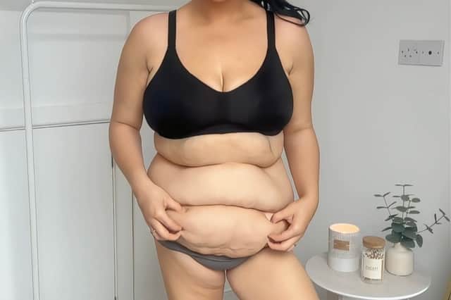 Jessica Rout, 29, first noticed her stomach looked different as a teenager