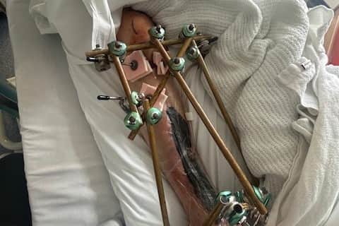 John Websdale's leg was shattered