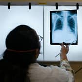TB is a bacterial infection that affects the lungs.