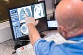 Yorkshire Cancer Research has recently started funding a new clinical trial which aims to give more people with lung cancer in Leeds and across Yorkshire the opportunity to take part in life-saving surgery.   