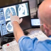 Yorkshire Cancer Research has recently started funding a new clinical trial which aims to give more people with lung cancer in Leeds and across Yorkshire the opportunity to take part in life-saving surgery.   