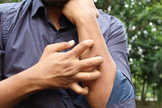 Scabies symptoms can take eight weeks to materialise.