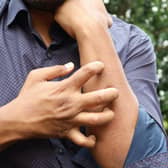 Scabies symptoms can take eight weeks to materialise.