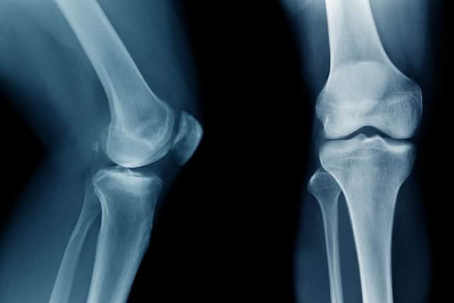 A shortage in medical cement could lead to delays in a number of patients getting hip and knee replacements and other pre-planned surgeries, experts have said.