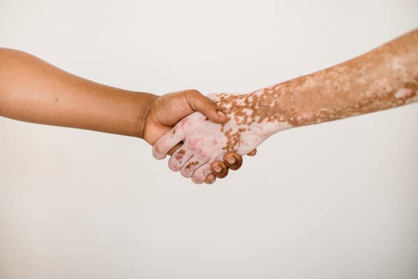 Around 1 in 100 people in the UK live with vitiligo.