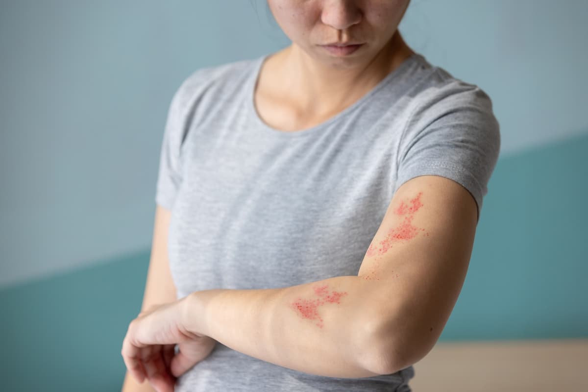 Gürtelrose-Warnung: Millionen Impfberechtigte gegen die „schwächende ...