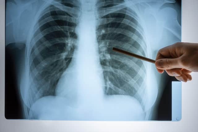 Mobile lung screening will be available to up to 90,000 residents in Leeds.