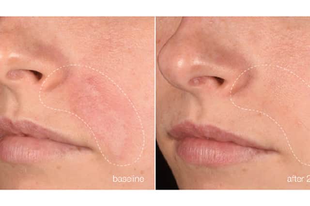 Before-and-after images show the appearance of reactive skin at baseline and after 28 days of using Dermalogica Stabilizing Repair Serum.
