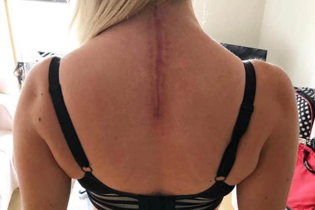 Gemma had seven hours of spinal surgery after tumours on her spine caused vertebrae to collapse