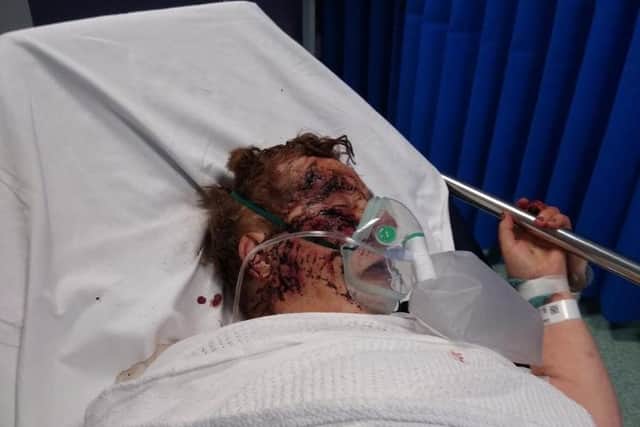 Mary Rollinson in hospital after the terrifying dog attack (Photo and words: Glen Minikin).