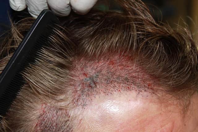 The hair transplant centre was rated unsafe in a recent CQC report