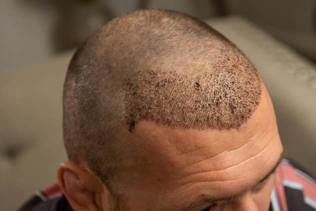 Former Leeds Rhinos player Shaun Lunt was back on the field three days after undergoing a seven hour hair transplant operation. Picture: SWNS