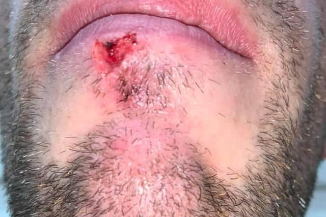 David sustained a wound to his lower lip in the alleged incident