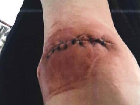 Banwh Salih's right elbow after the surgery in March 2017.