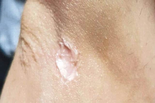 Banwh Salih's right elbow before surgery