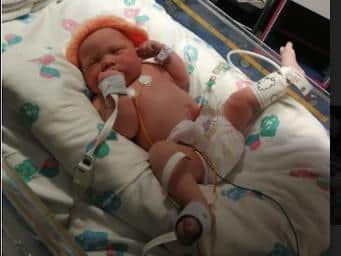 Lilly Broome pictured in hospitral soon after being born