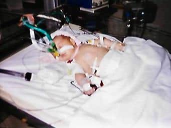 Philippa Barraclough pictured after her heart surgery at Killingbeck Hospital when she was a one week old baby.