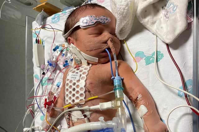 Charlotte Hillyard's baby boy Charlie, pictured recovering from open heart surgery at Leeds Children's Hospital, where he has been since he was born.