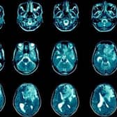 Leeds professor believes new approach of treating brain cancer could be effective in stopping glioblastomas growing
cc University of Leeds