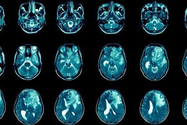 Leeds professor believes new approach of treating brain cancer could be effective in stopping glioblastomas growing
cc University of Leeds