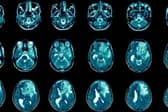 Leeds professor believes new approach of treating brain cancer could be effective in stopping glioblastomas growing
cc University of Leeds