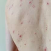 Symptoms of chickenpox are often very mild in children, ranging from an uncomfortable itchy rash to a slight fever. Photo: PA