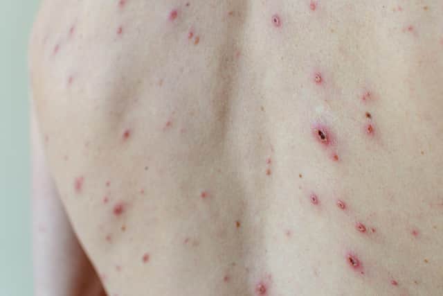 Symptoms of chickenpox are often very mild in children, ranging from an uncomfortable itchy rash to a slight fever. Photo: PA