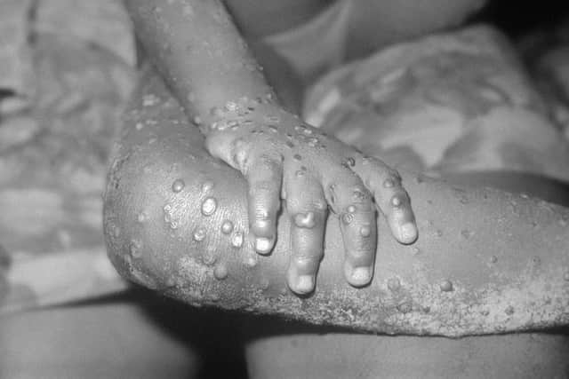 Monkeypox-like lesions are shown on the arm and leg of a female child in Bondua, Liberia. Photo: Getty Images