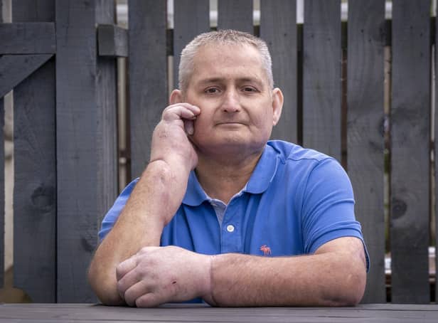 Steven Gallagher, from Dreghorn, Ayrshire, is the first person in the world to have a double hand transplant after suffering from the rare disease scleroderma.
PA