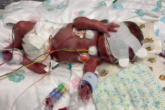 Both babies spent months in hospital undergoing surgeries, transfusions and treatment.