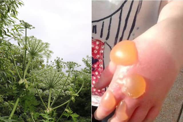 Coming into contact with Giant Hogweed can cause painful blisters (Photo: Incredible Edible / SWNS).