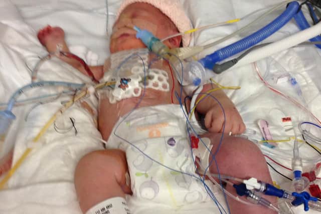 Martha, pictured as a new born, in recovery from her open heart surgery.