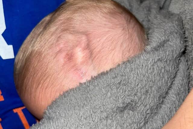 A photo of the bulging vein's on baby Carson Murgatroyd's head around six weeks after he was born.