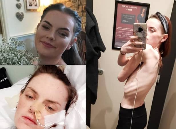 Emily Webster, 27, suffers from severe Gastroparesis - a long term, rare and chronic condition that means the nerves and muscles in her stomach are in a state of paralysis.
Pic: Emily Webster