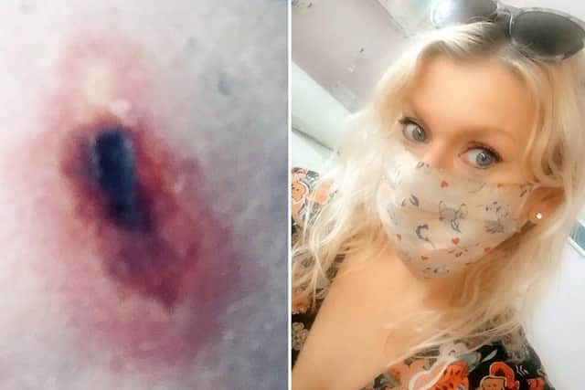 Jo Kenyon, 34, was sat on the toilet when the insect - thought to be a false widow - scurried out and sunk its fangs into her thigh.
PIC: SWNS