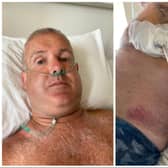 Mark Jepson suffered a punctured lung and broken ribs in the motorbike crash.