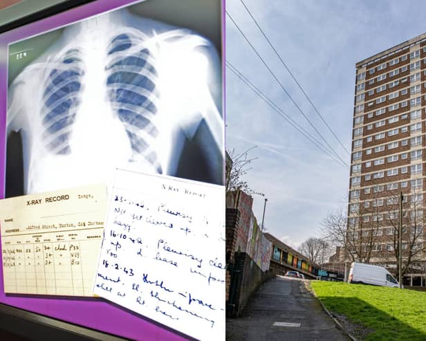 A six-month project was launched in Armley to help people get treatment for TB (Stock photo by National World)