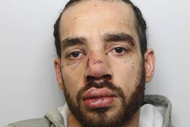 Crawford with the broken nose he suffered when his girlfriend fought back. (pic by WYP)