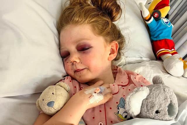 Wakefield schoolgirl Lily-Mae West broke 15 bones in her skull after getting hit by a zorbing ball (Photo by Day One Trauma Support/SWNS)