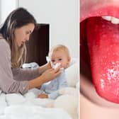 A child's tongue with scarlet fever, right, of which cases are rising alongside Strep A in England. Pictures: PA/Adobestock.
