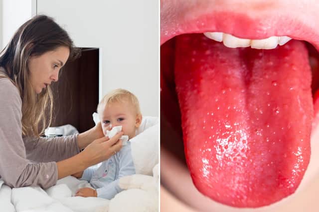 A child's tongue with scarlet fever, right, of which cases are rising alongside Strep A in England. Pictures: PA/Adobestock.