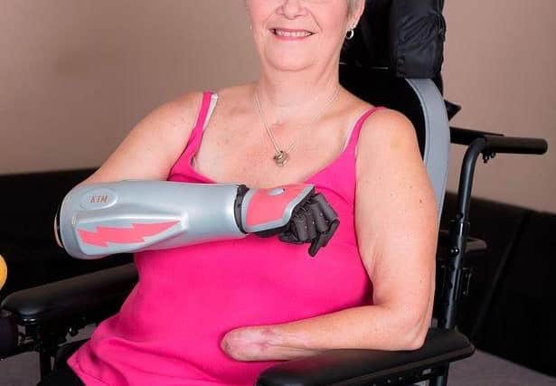 Before the transplant Kim found prosthetic hands too cumbersome and of limited use