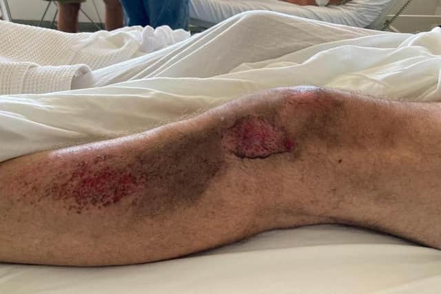 Mark also suffered grazes to his body from the crash.