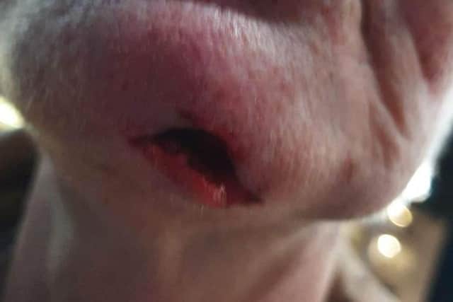 Lorna Lee Thynne said she was attacked and stabbed in the chin while walking her dogs in Horsforth
