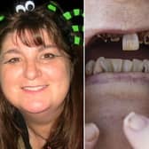Mandy Sharp lost 13 teeth after being unable to get a dentist appointment for seven years