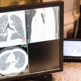Combined lung and kidney scan